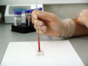 Tipuri de melanom si factorii de risc melanom