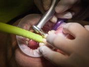 4 lucruri pe care trebuie sa le stii inainte sa-ti pui un implant dentar implant dentar
