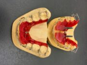 Ce trebuie sa stii cand iei in calcul aplicarea unui aparat dentar Clinica dentara Elveto Dent