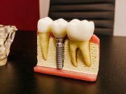 Implant dentar in Bucuresti, tehnologie de ultima generatie si lucrari stomatologice durabile stomatologie sector 6